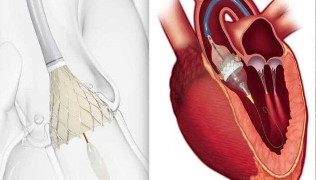 Cost of TAVR in Hyderabad