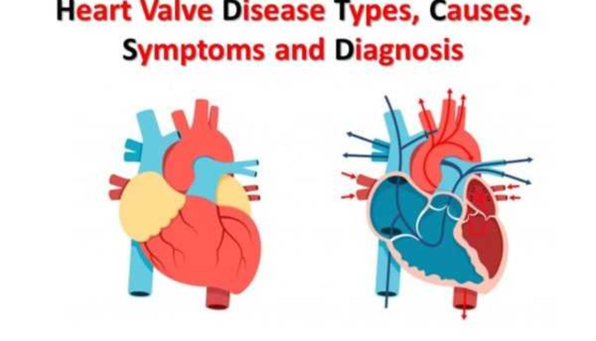 heart valve disease