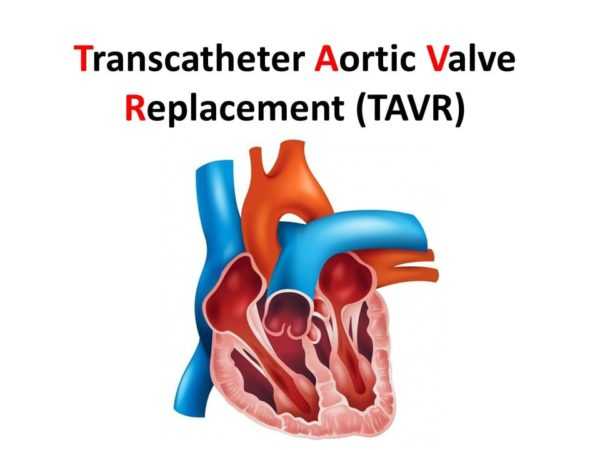 Heart valve replacement surgery in Hyderabad