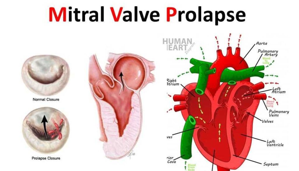 mitral valve prolapse