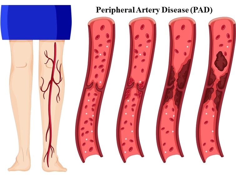 peripheral artery disease (PAD)