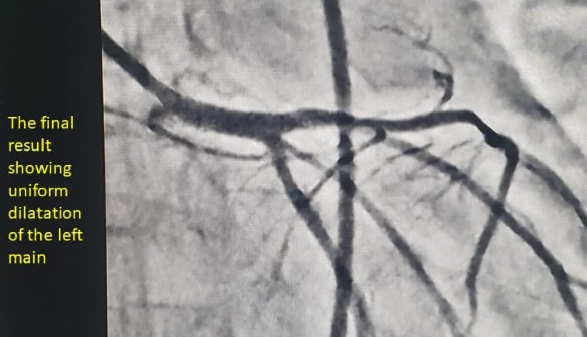 left main coronary artery stenosis