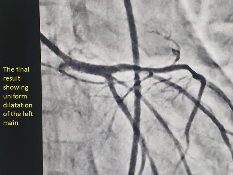 left main coronary artery stenosis