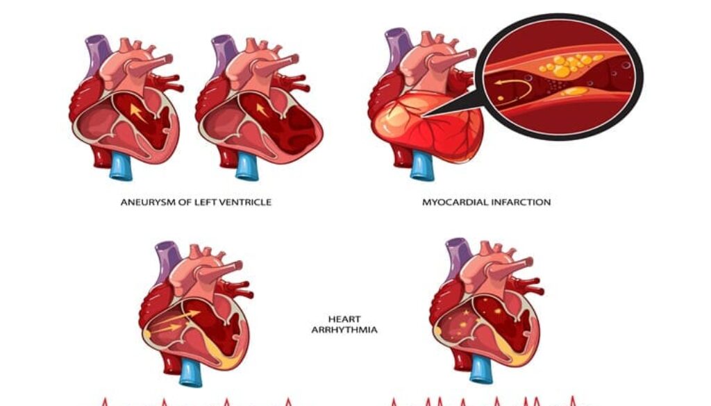 cardiogenic shock symptoms