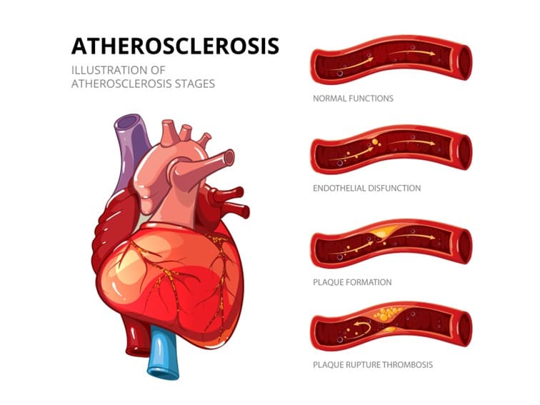 5 causes of heart disease